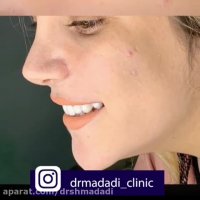 8 واحد لمینت سرامیکی ایمکس