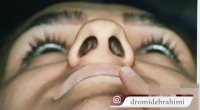 عمل انحراف بینی پهن توسط بهترین جراح بینی دکتر امید ابراهیمی