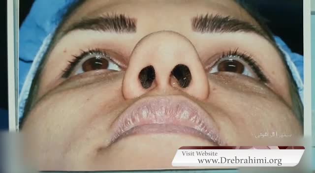 جراحی بینی گوشتی توسط بهترین جراح بینی تهران