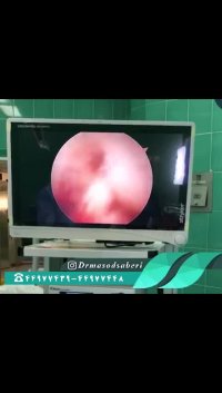 نتیجه بازسازی رباط صلیبی به روش آرتروسکوپی