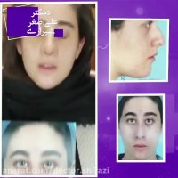 فیلم برداشتن گچ بینی و تغییر چهره بعد از عمل بینی