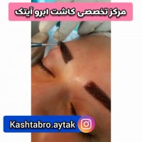 کاشت ابرو پرتراکم | کلینیک آیتک | 44221324-021