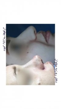 جراحی قوز بینی