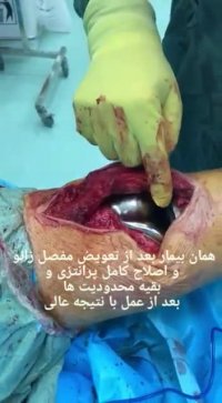 درمان زانوی پرانتزی بعد از تعویض مفصل زانو