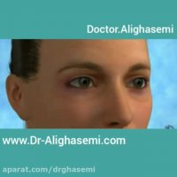 جراحی زیبایی پلک 5