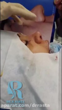 فیلم از انحراف بینی