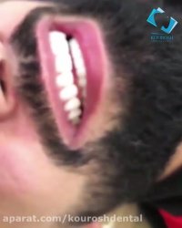 عکس قبل و بعد کامپوزیت دندان | ویدیو کامپوزیت دندان در مشهد | کلینیک کوروش