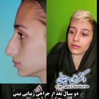 دو سال بعد از جراحی بینی توسط دکتر میقانی