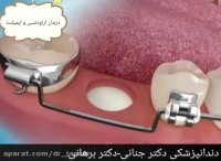 درمان ارتودنسی و ایمپلنت بطور همزمان