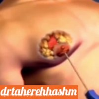 ژنیکوماستی در مردان