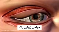 فیلم شماتیک جراحی زیبایی پلک