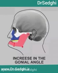 مشکلات تحلیل رفتن دندان ها
