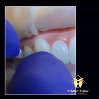 کامپوزیت دندان چگونه است؟