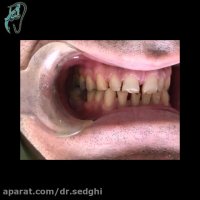 پرسلن لامینت ونیر
