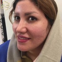 کاشت ابرو | کلینیک تخصصی رنسانس  021-22088210