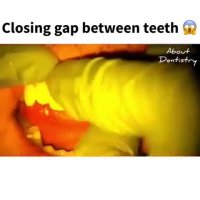 بستن دیاستم (فاصله بین دندانی)