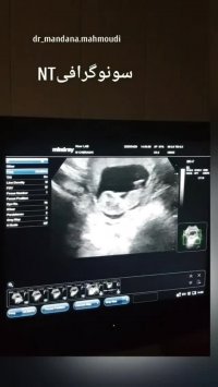 سونوگرافی NT در اهواز