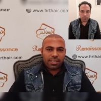 کاشت مو رنسانس - کلینیک تخصصی رنسانس