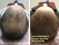 اسکالپ اقایان