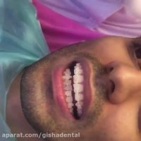 ارتودنسی نامرئی - براکت سرامیکی