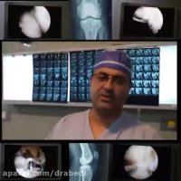 بازسازی همزمان رباط صلیبی قدامی و خلفی