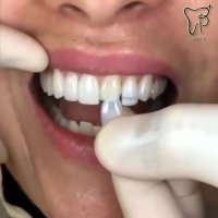 تفاوت لمینیت با دندان طبیعی