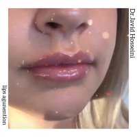 فیلم تزریق فیلر لب