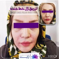 تزریق ژل خط خنده در کلینیک ارکیده