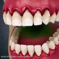 تحلیل رفتن لثه و لق شدن دندان ها بر اثر جرم