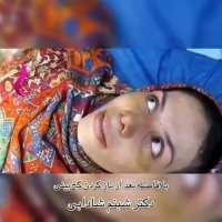 فیلم باز کردن گچ بینی بعد از عمل جراحی زیبایی بینی