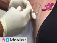 تزریق بوتاکس درمان تعریق بیش از حد-زیر بغل