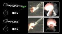 Piranha laser enucleation system from Richard Wolf