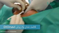 ایمپلنت دندان به روش DIOnavi