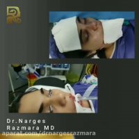 عمل بینی گوشتی