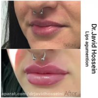 تزریق ژل هیالورونیک اسید