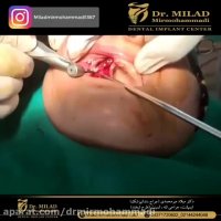 انجام 16 واحد ایمپلنت در یک روز