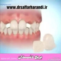 فیلم بریج دندان