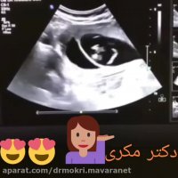 سونوگرافی چند قلویی