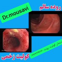 کولیت روده درمان‌ شد