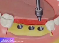 ایمپلنت دندان فوری