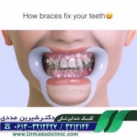 چگونگی اصلاح دندان ها با ارتودنسی