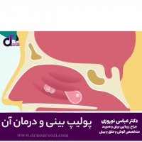 پولیپ بینی و راه های درمان آن