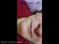 تزریق ژل خط خنده