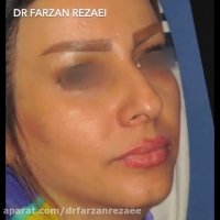 زاویه سازی فک گونه و چانه همراه با جراحی بینی