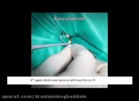 فیلم مراحل عصب کشی دندان