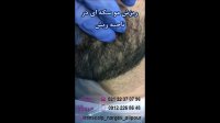 درمان ریزش مو سکه ای ریش خانم نرگس علیپور