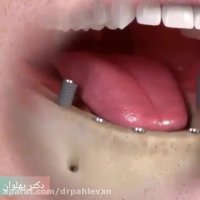 مراحل انجام ایمپلنت دندان