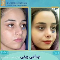 عمل زیبایی بینی