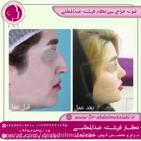 قبل و بعد از جراحی بینی با دکتر فرشته عبدالمطلبی