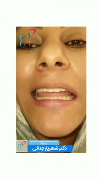 جراحی ایمپلنت کل فک پایین